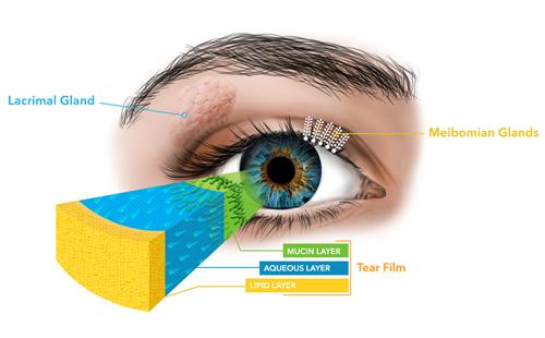 Understanding MGD, the leading cause of dry eye