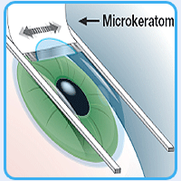 the microkeratome - ultra-thin (and sharp) razor blade