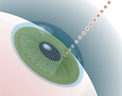 The IntraLase laser creates the corneal flap so that the laser in the next step can perform the microscopic proceedure to correct your vision.