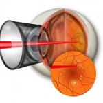 Laser photocoagulation for treatment of eye infections