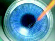 The IntraLase creates a corneal flap of uniform thickness