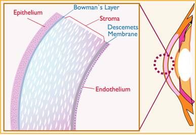 IntraLase History - Advancement in LASIK Technology