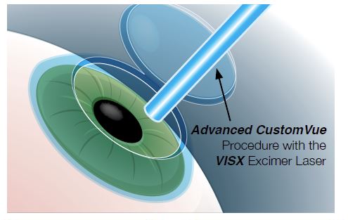 Elevate Clarity: Advanced LASIK Vision Enhancement